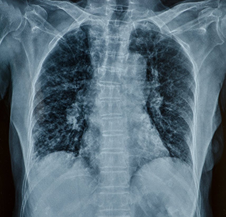 Spinal Cord Injury from an Omaha Car Accident