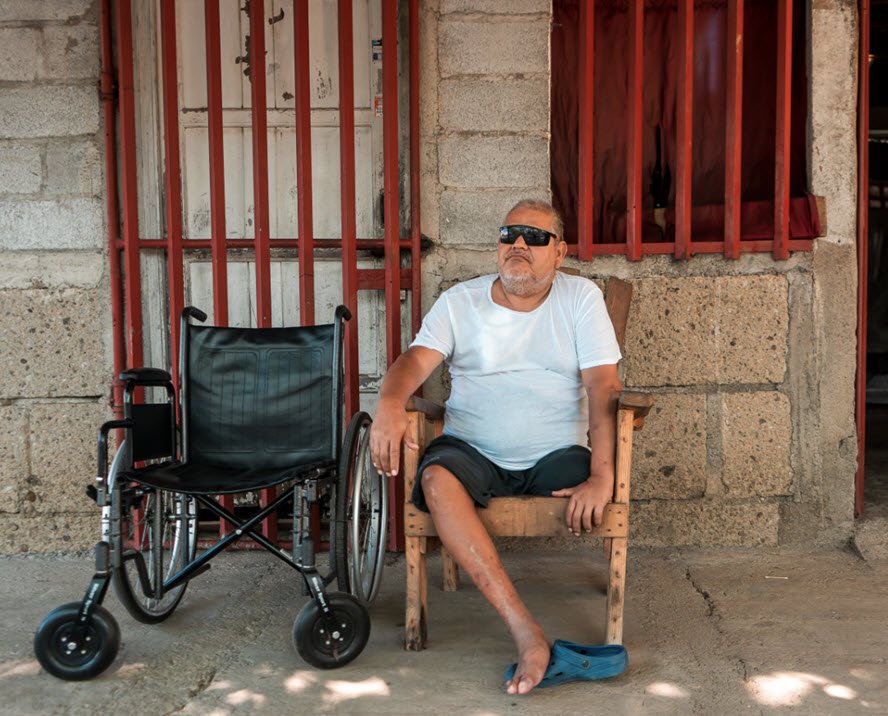 Amputation Caused from a Work Accident