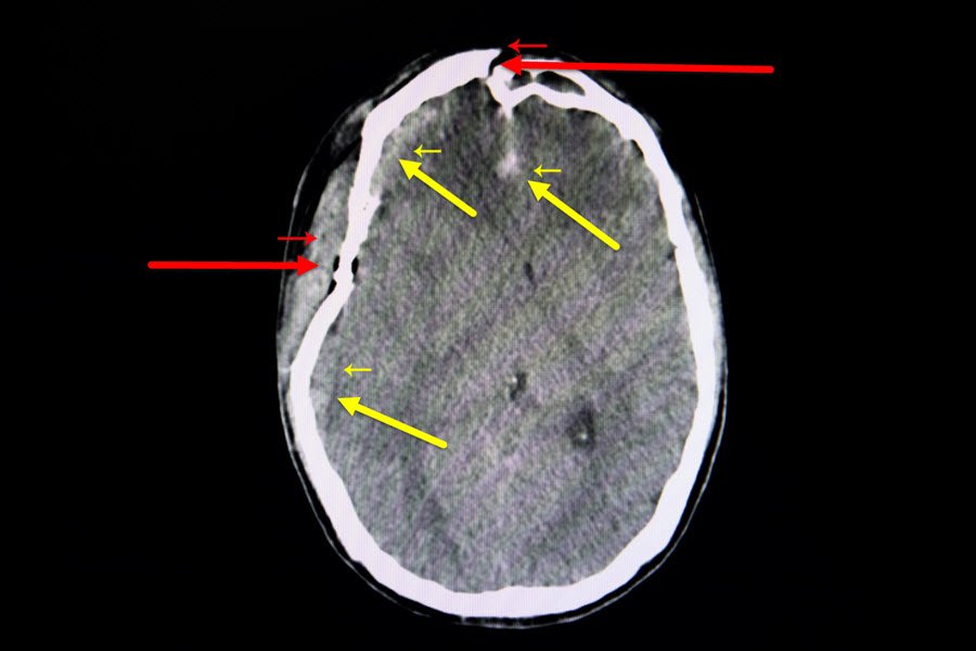 What Are Catastrophic Injury Cases
